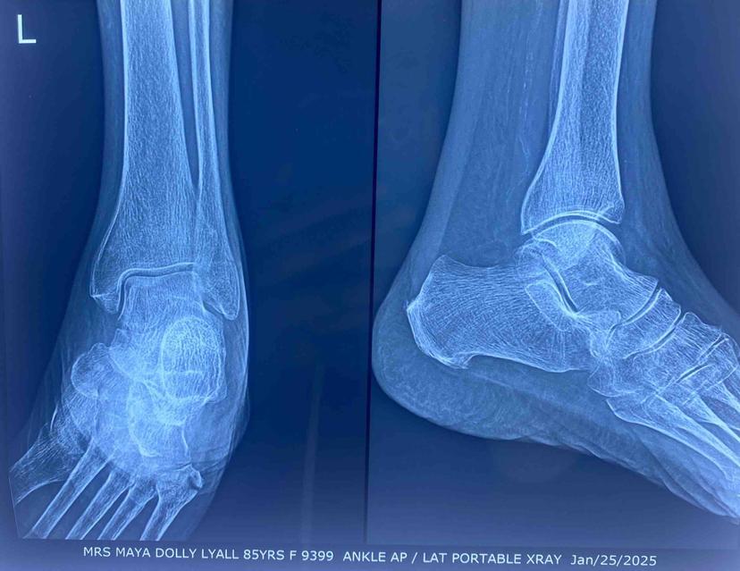 Ankle AP/LAT portable X-ray
