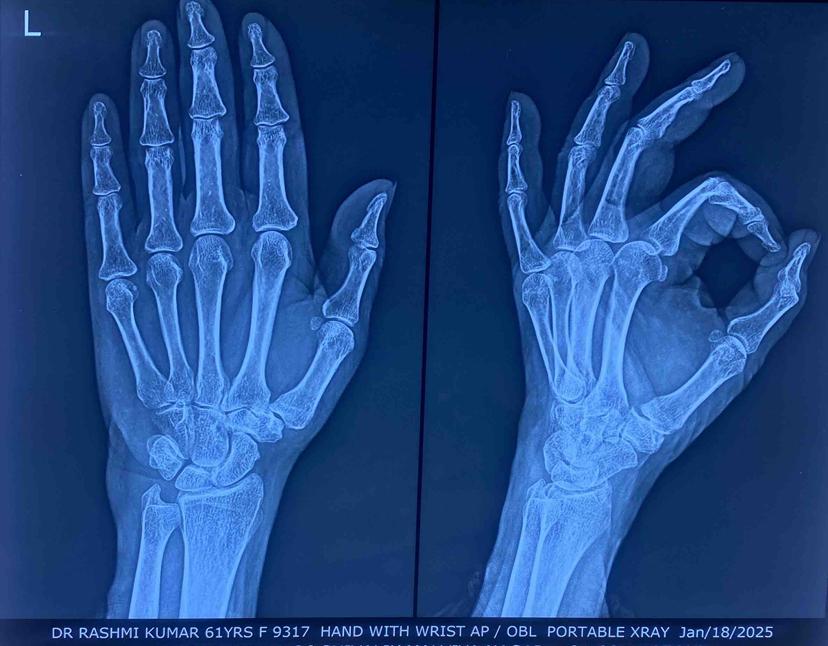Hand AP/OBL portable X-ray
