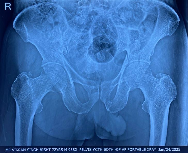 Pelvis with both hips AP portable X-ray
