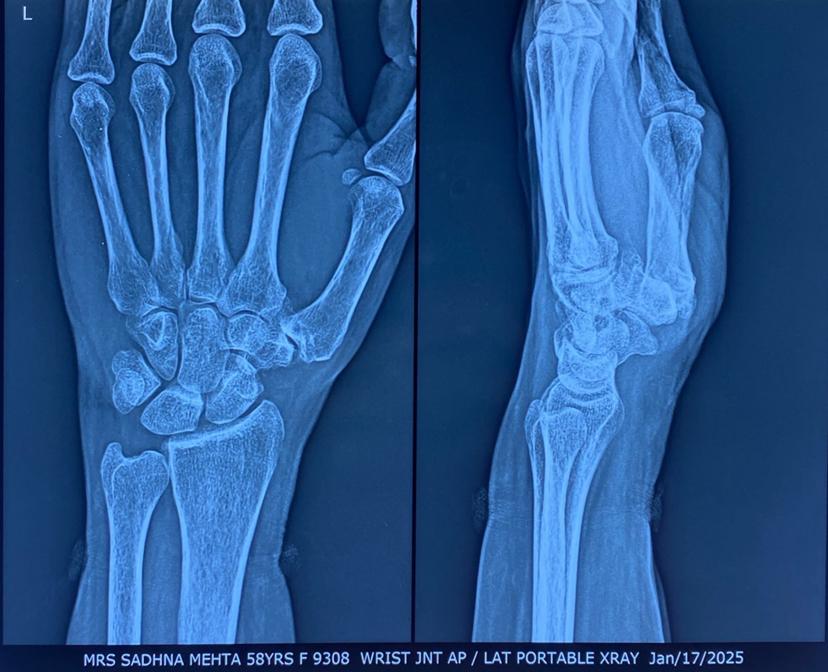 Wrist joint AP/LAT portable X-ray